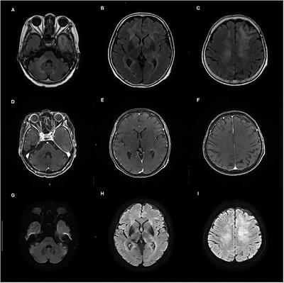 Case Report: Paraneoplastic Hashimoto's Encephalopathy Associated With Lymphomatosis Cerebri With Periodic Synchronous Discharges Resembling Creutzfeldt–Jakob Disease